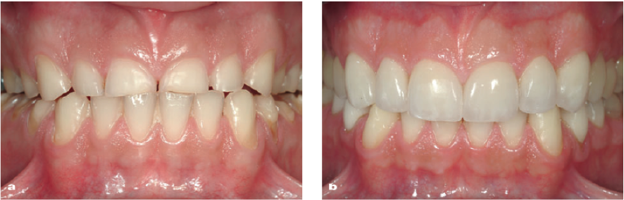 erosión dental2.png